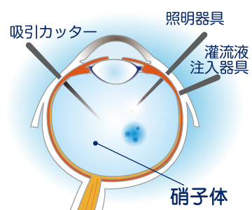 硝子体手術について